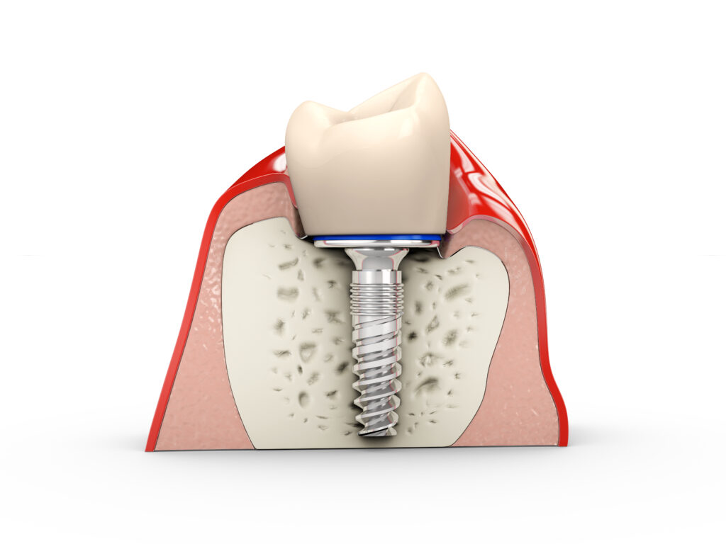 Single Tooth Implant